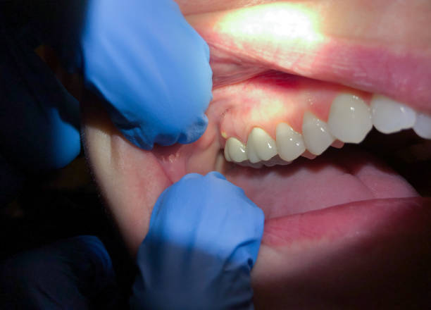 Best Broken or Cracked Tooth Emergency Dentist in North Warren, PA